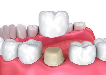 Dental Crowns 001