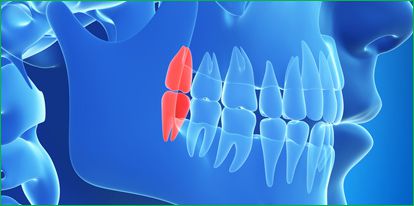 wisdomteeth