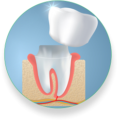 Dental Crowns 005