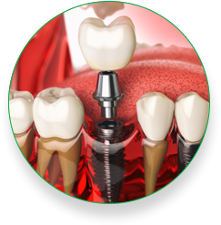 Implants -  Family Dentistry