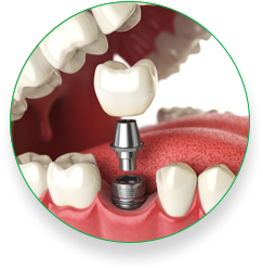 Dental Implants 002