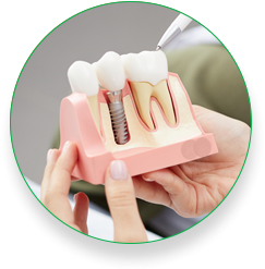 Dental Implants 004