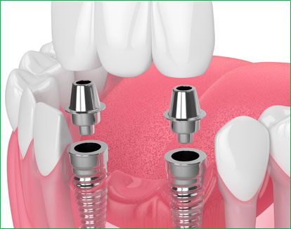 Dental Implants 001