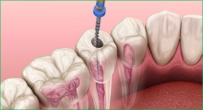 Root Canal 001