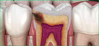 Root Canal 008