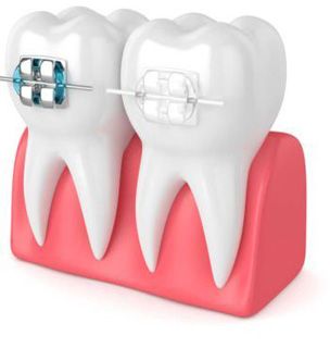 traditional braces