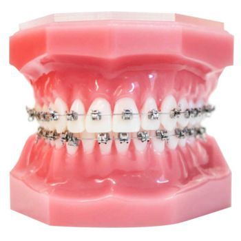 Metal Braces 1 350x350