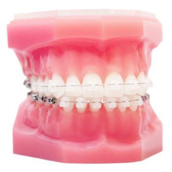 Clear Braces 350x350