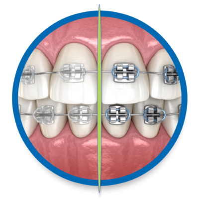 TraditionalBraces2 400x400