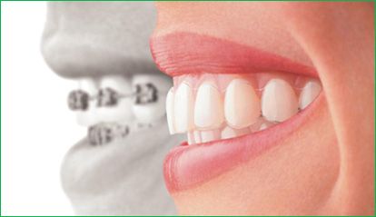 teeth using invisalign