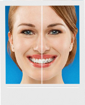 Woman Face With Invisalign Vs Traditional Braces